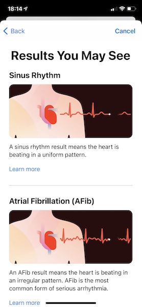 Watch ECG