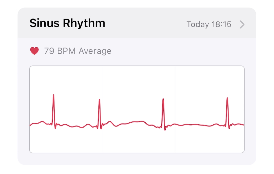 Watch ECG