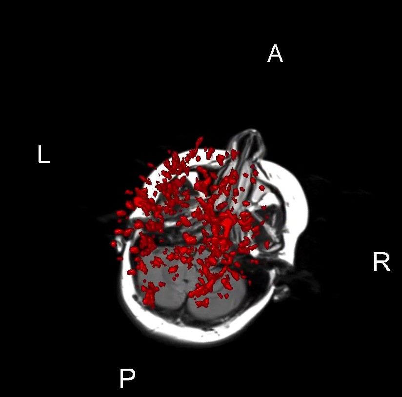 MRI scan