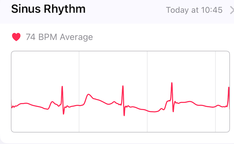 Apple Watch ECG output
