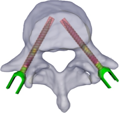 placement of pedicle screws in vertebra