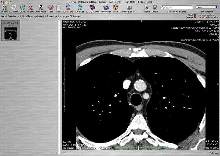 OsiriX imaging